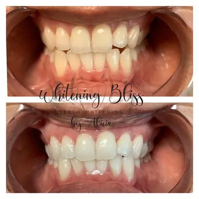 29094 teeth whitening san jose ca image3