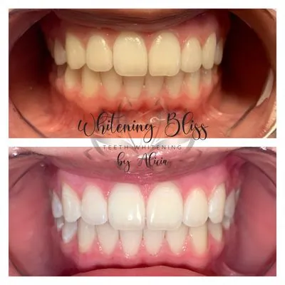 29094 teeth whitening san jose ca image4