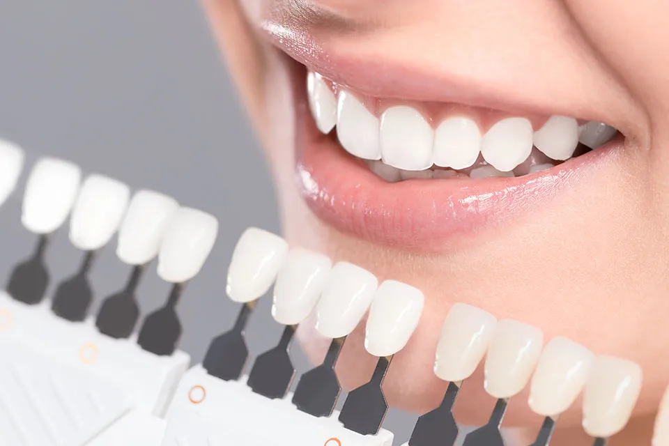 29094 teeth whitening san jose ca image6