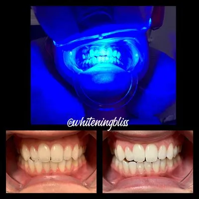 /img/29094-teeth-whitening-san-jose-ca-image7.webp