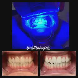 /img/29094-teeth-whitening-san-jose-ca-image7.webp