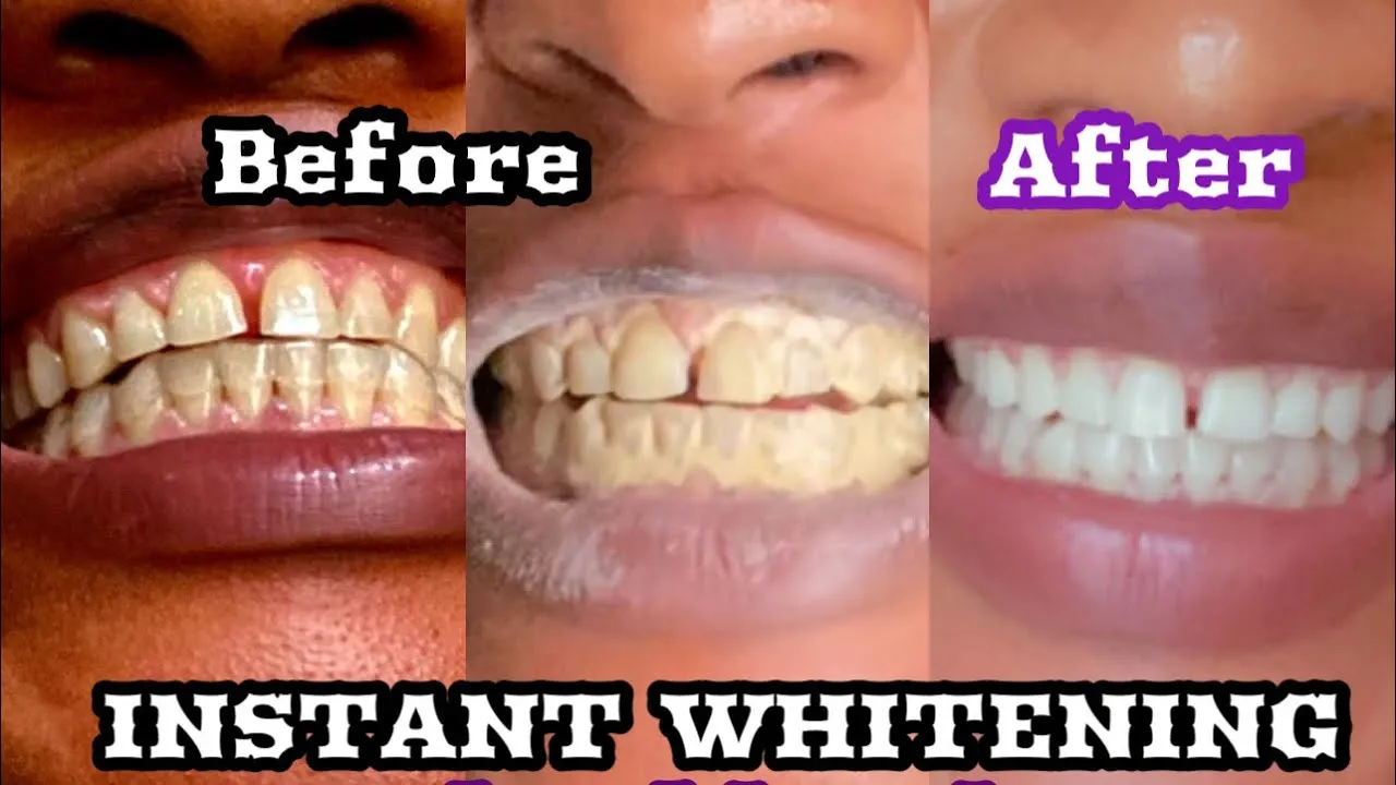 29095 at home whitening kits