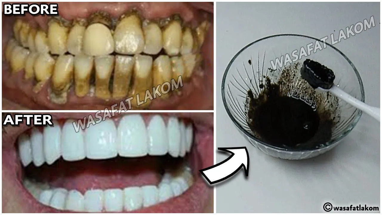 29095 baking soda teeth whitening