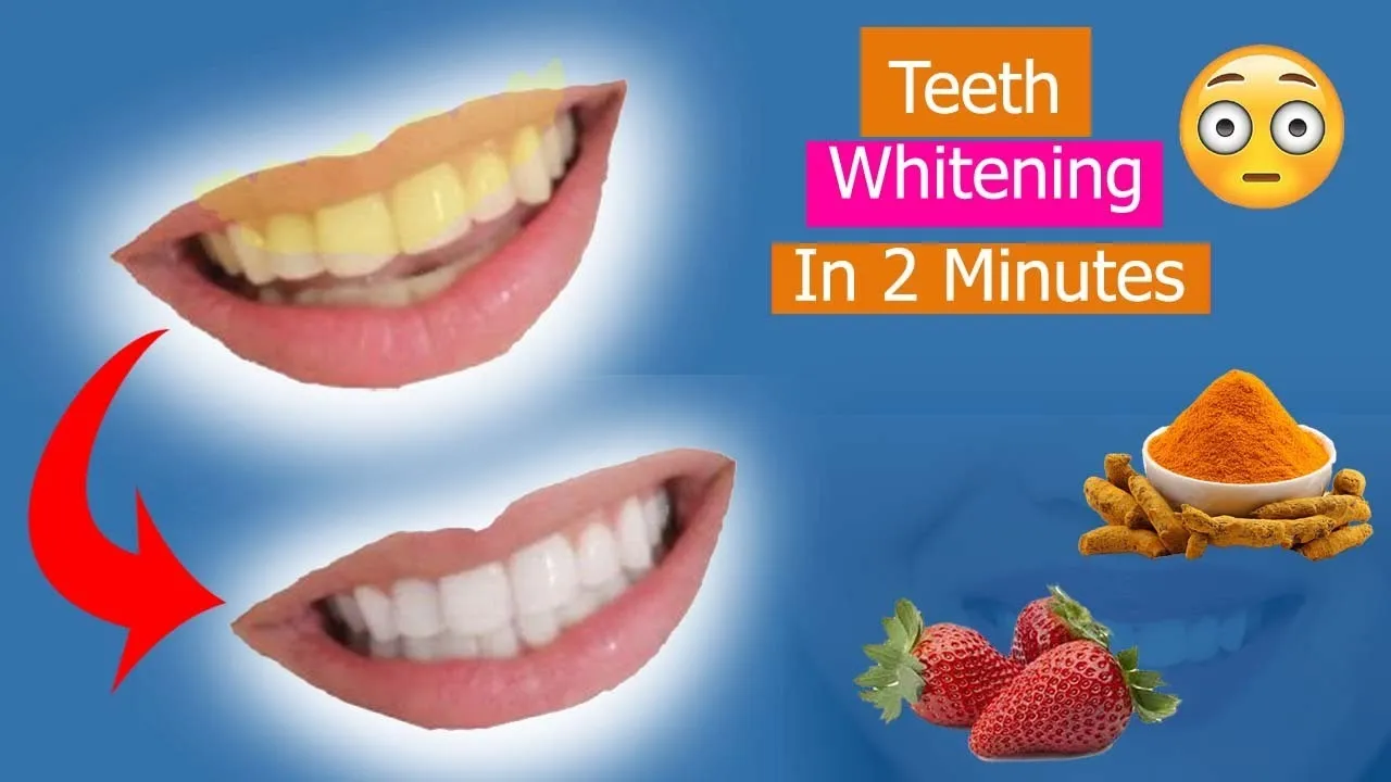 29095 professional teeth whitening