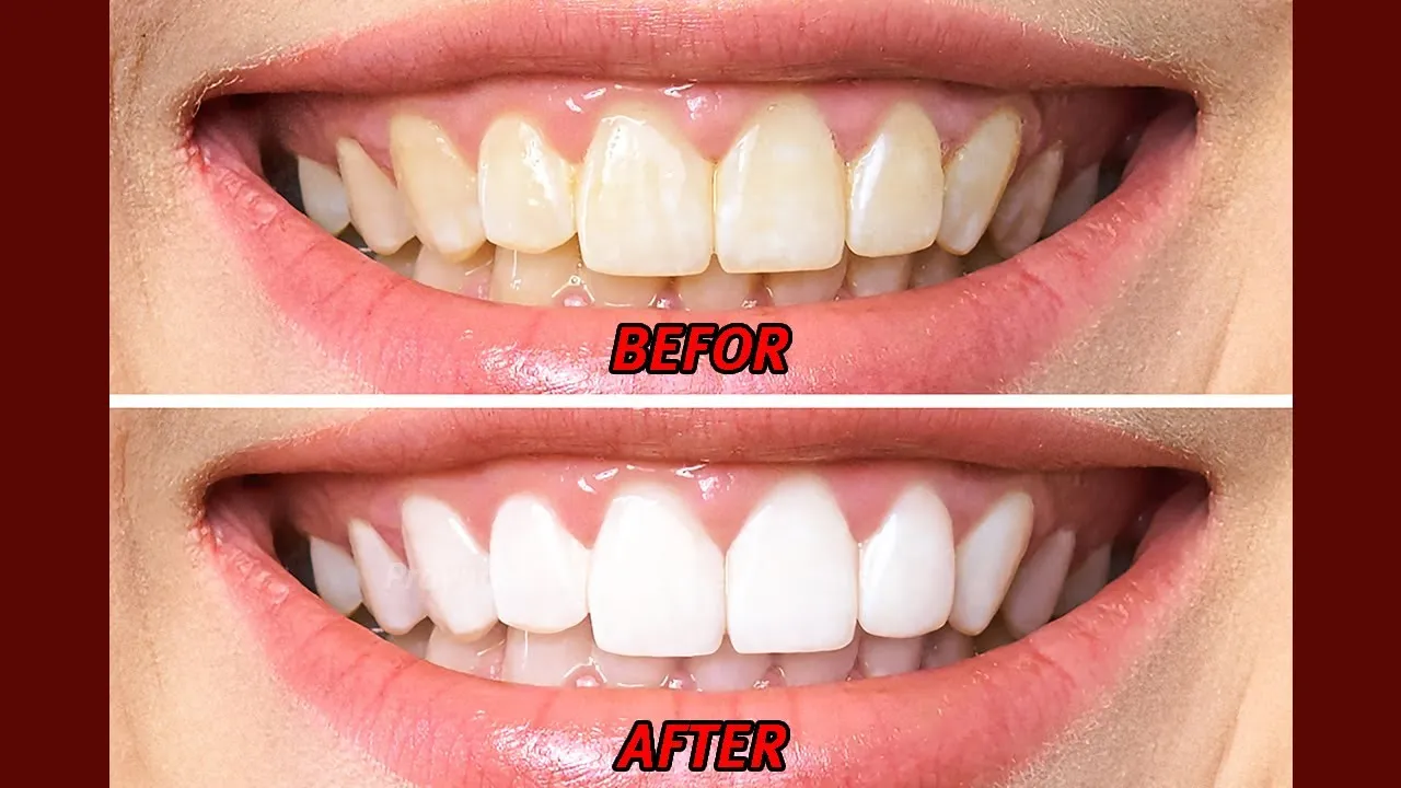 29095 teeth whitening strips