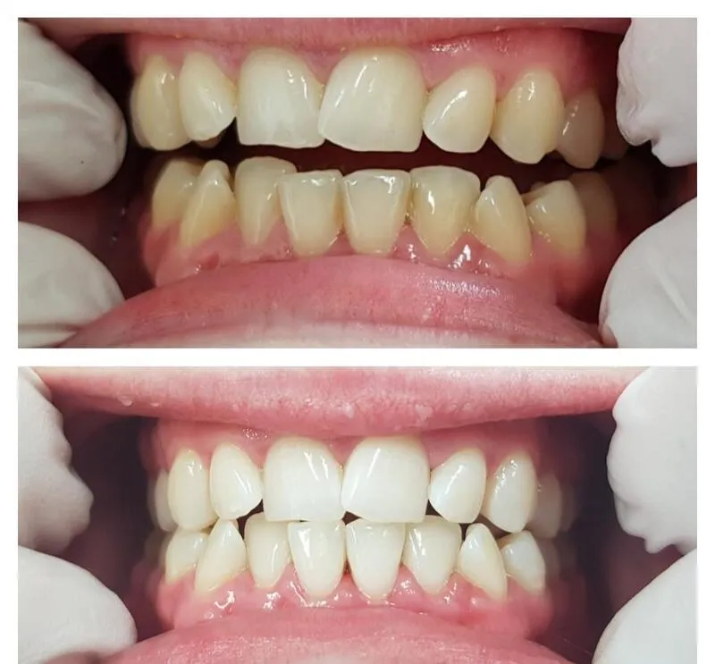 29101 maintaining white smile