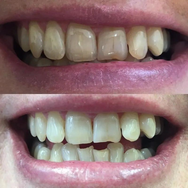 29101 teeth whitening options