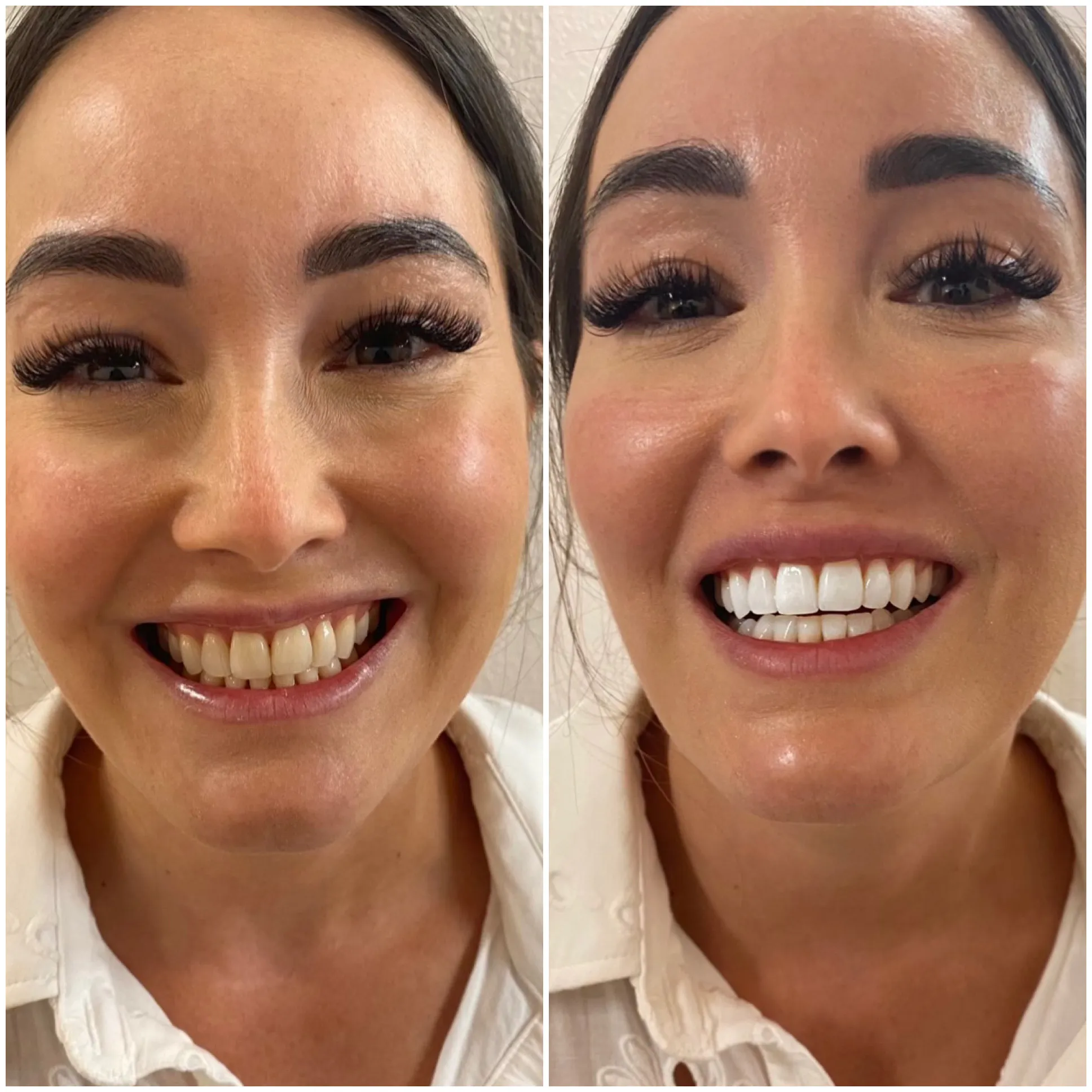 29102 at home dental whitening products