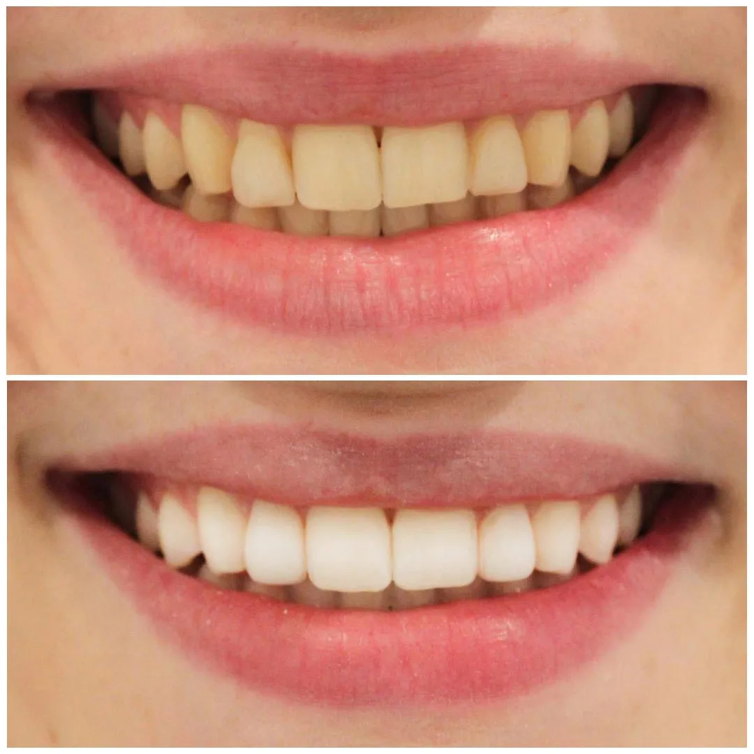 29102 dental whitening results image