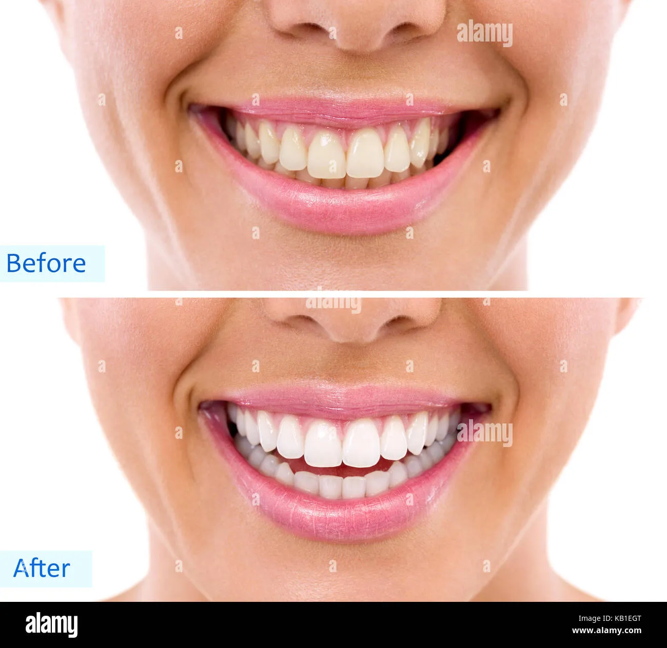 /img/29102-is-dental-whitening-right-for-me.webp