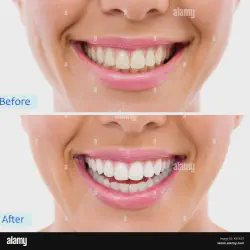 /img/29102-is-dental-whitening-right-for-me.webp