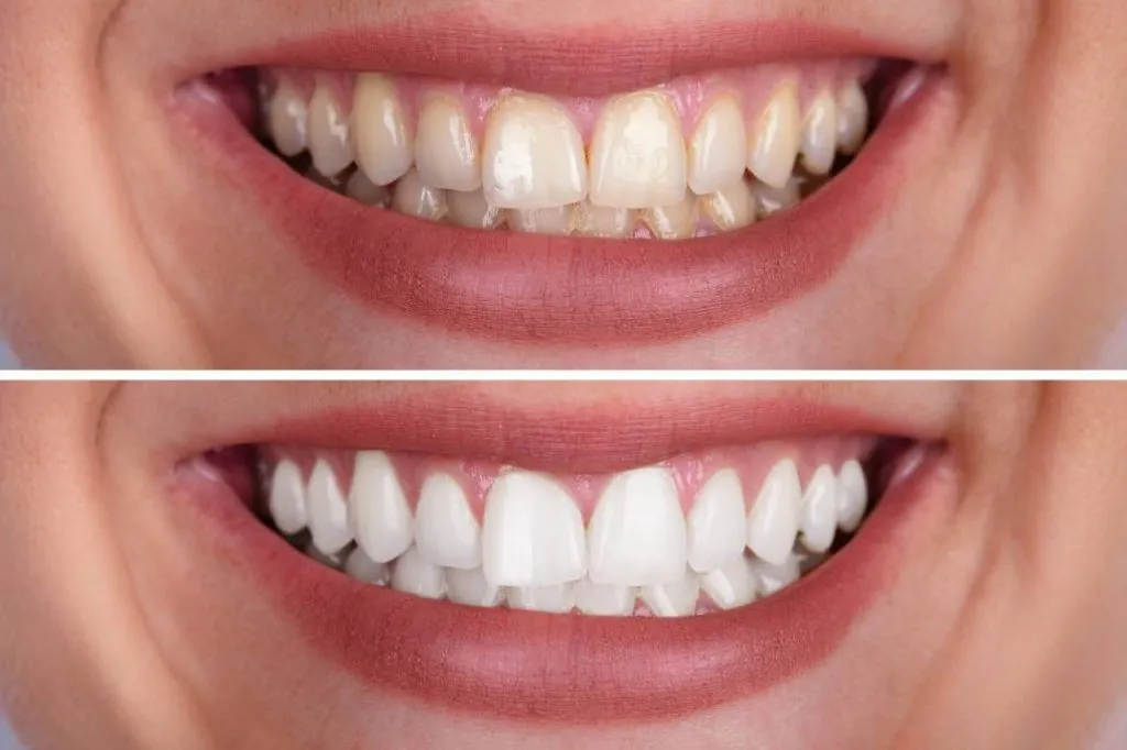 29102 sensitivity after dental whitening