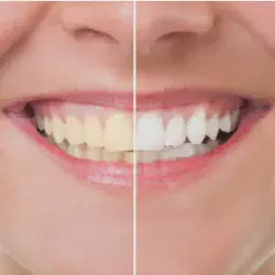 /img/29104-maintaining-white-smile.webp