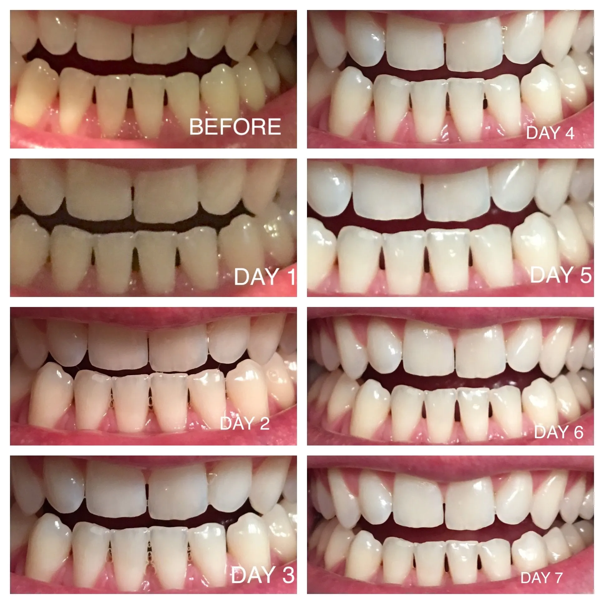 29106 teeth whitening strip application
