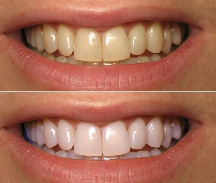 29106 teeth whitening strip pros cons