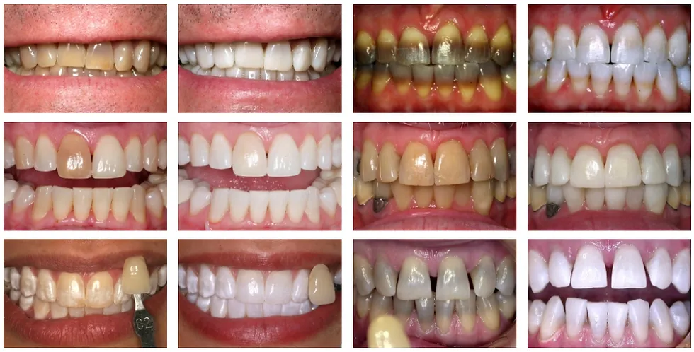 29106 teeth whitening strips