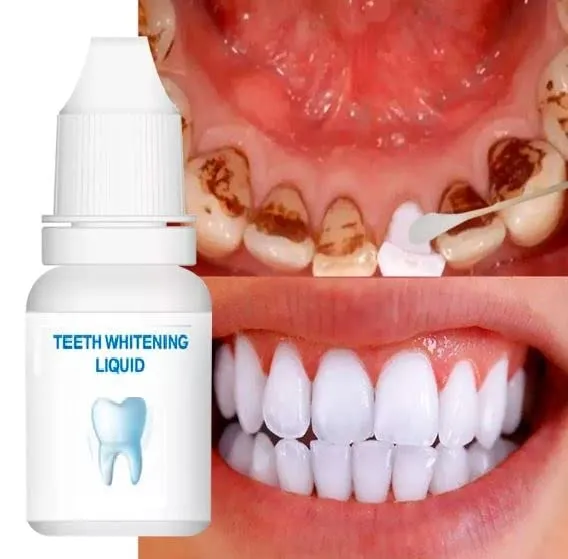 29107 teeth whitening usa smile