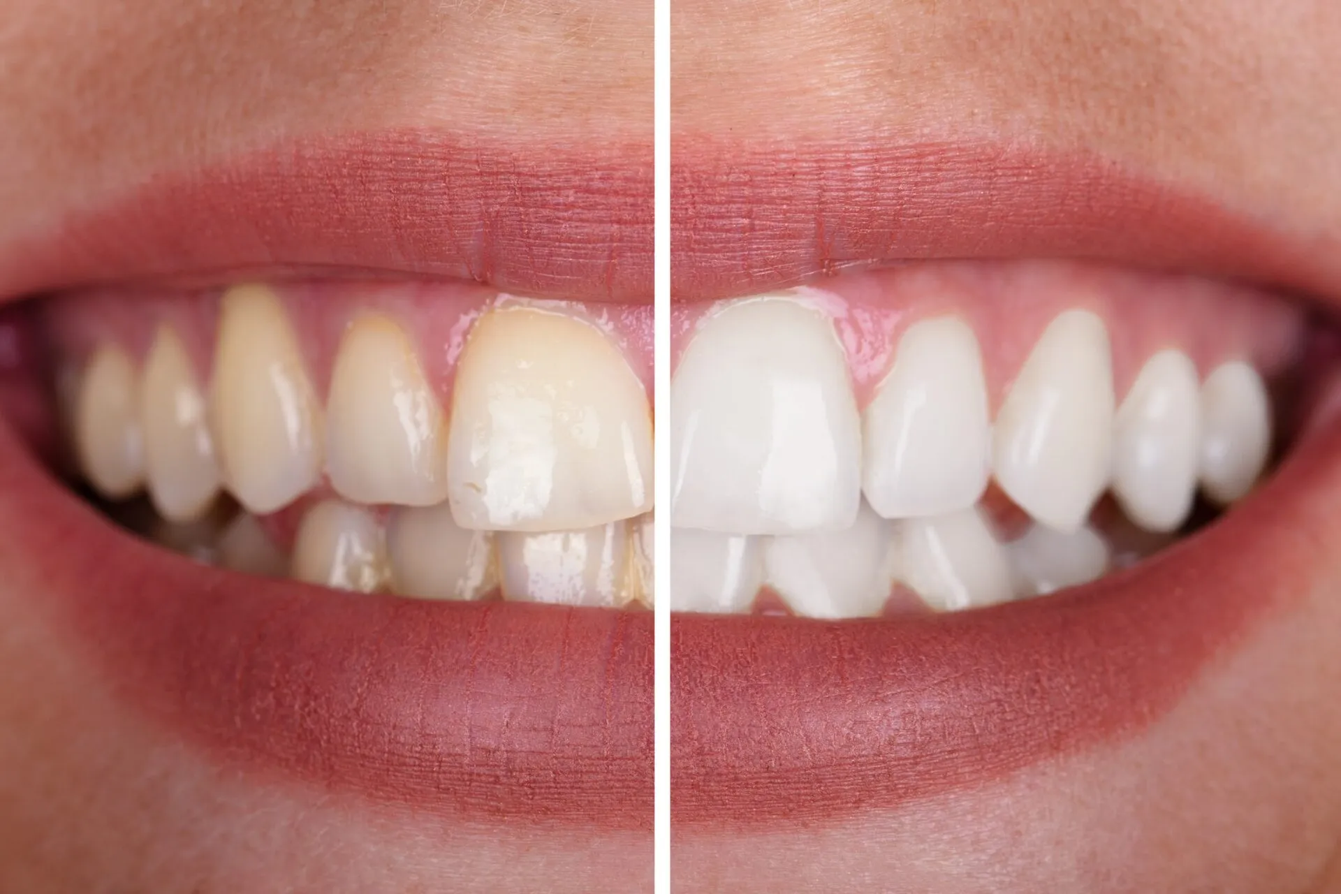 29108 dentist teeth whitening
