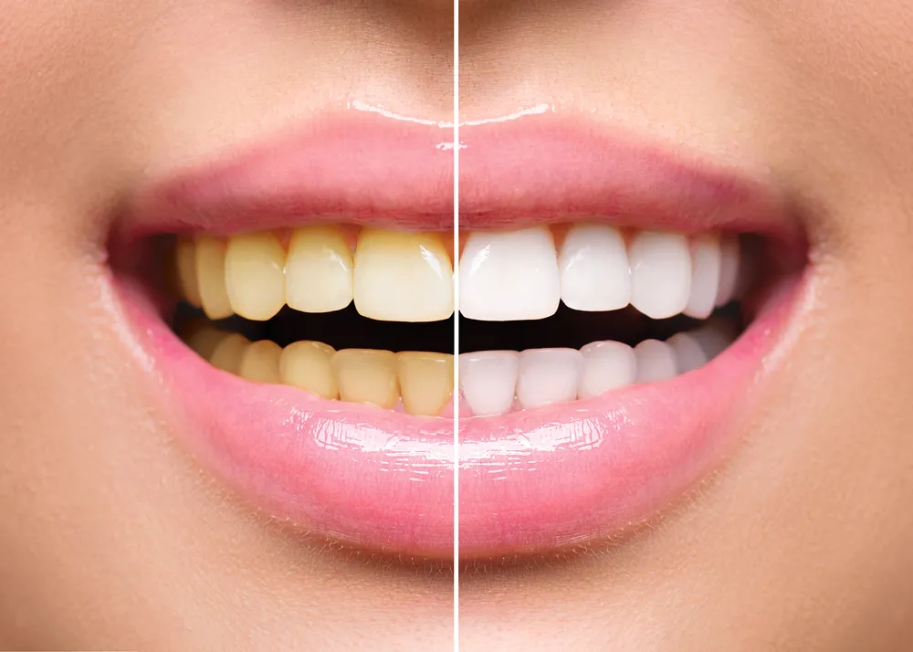 29108 teeth whitening results