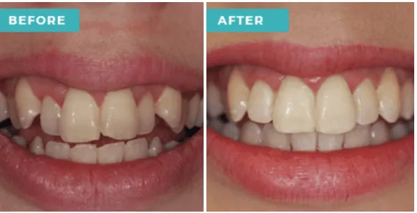 29108 teeth whitening smile