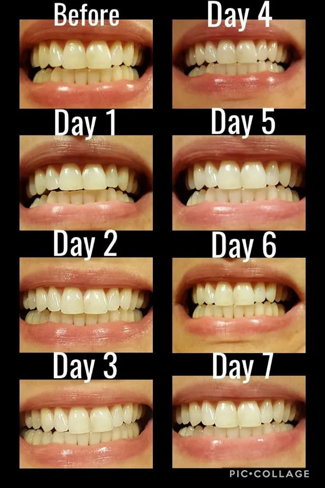 29110 day white teeth whitening gel