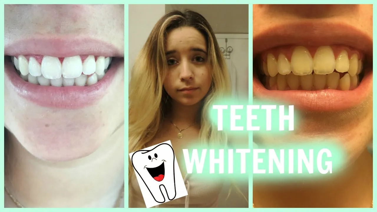 29110 day white whitening system