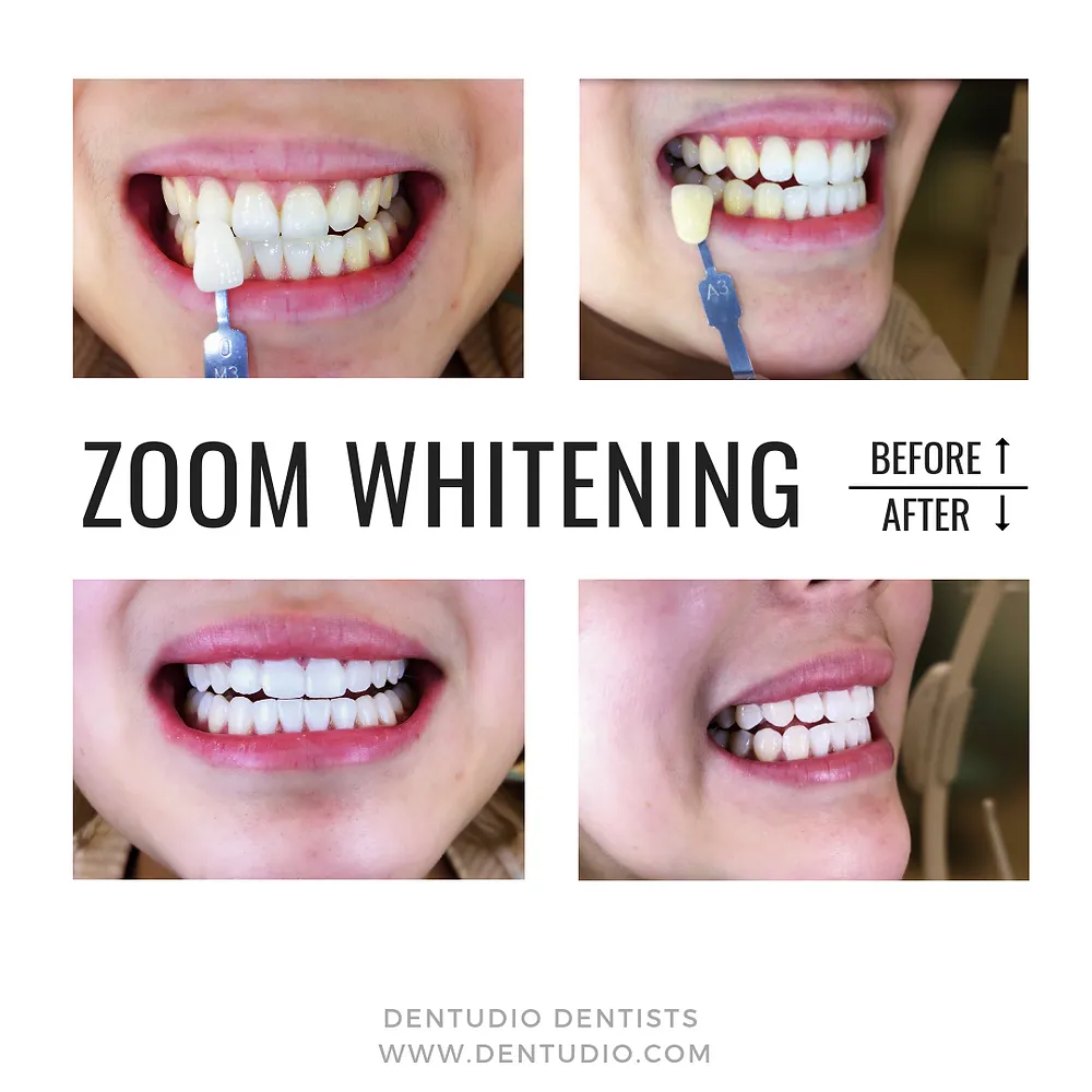 29110 teeth whitening before after
