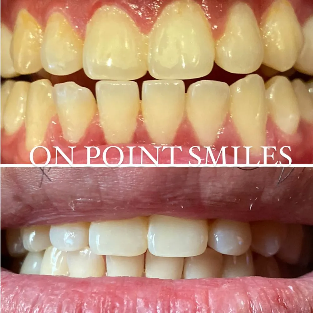 29112 teeth whitening las vegas 2