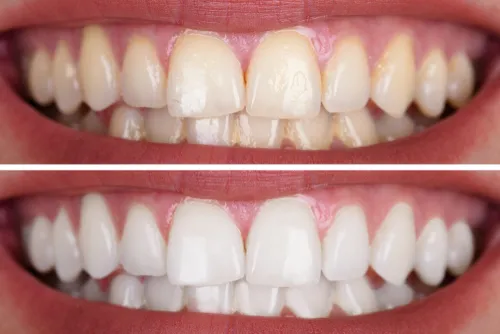 29112 teeth whitening las vegas 3