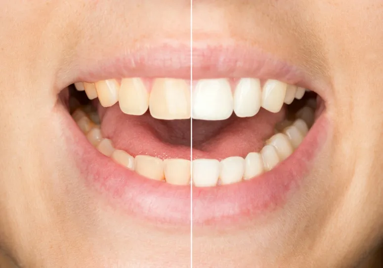 29112 teeth whitening las vegas 6