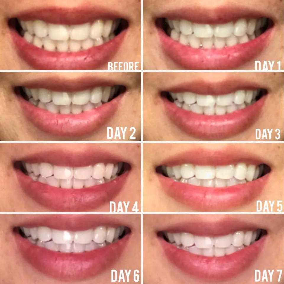 29114 teeth whitening cost