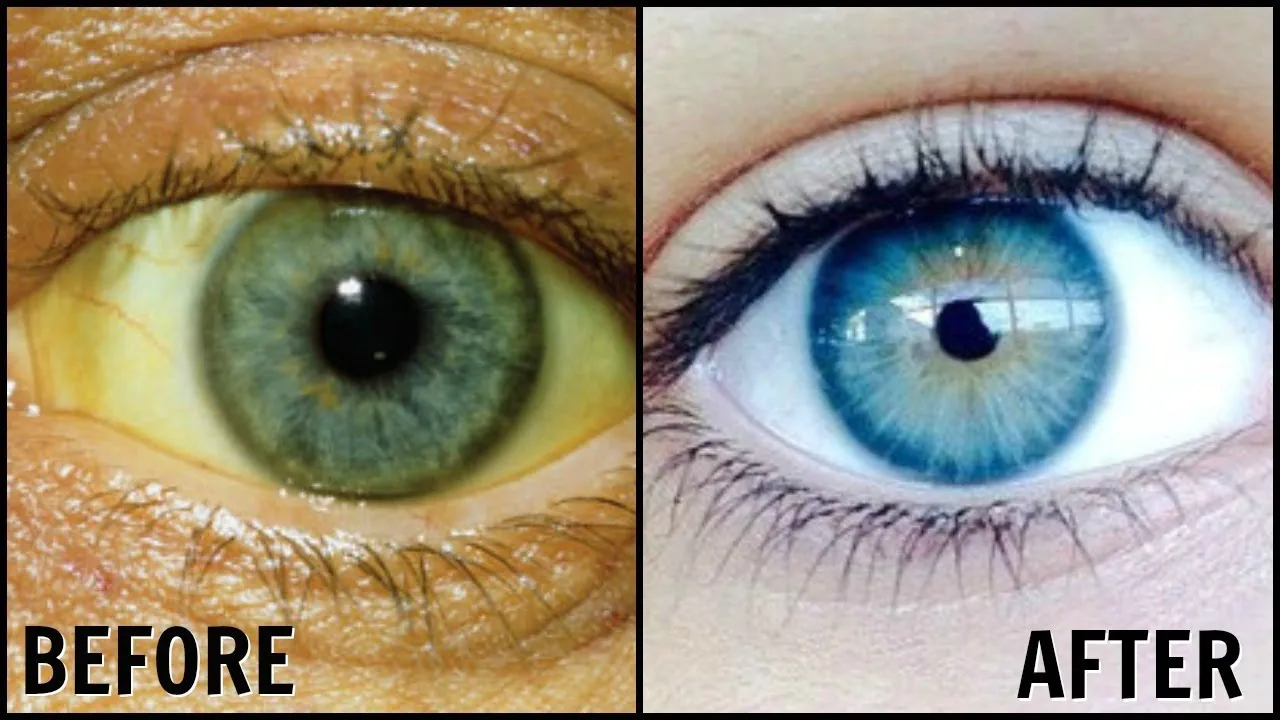 29115 red eyes causes