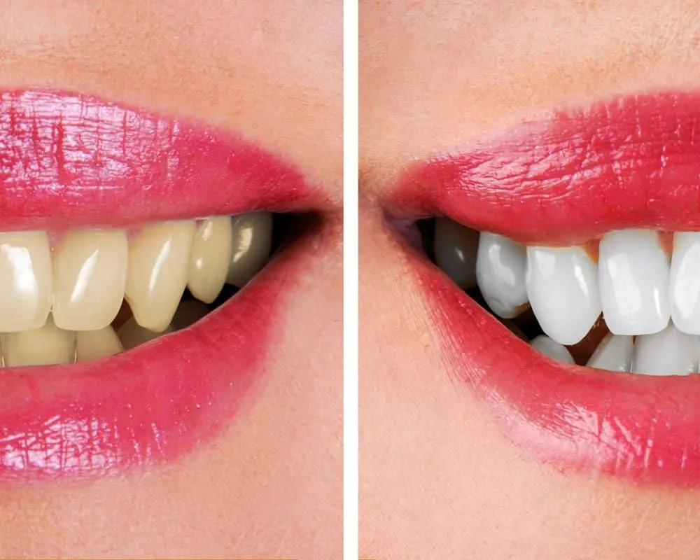 29116 teeth whitening before and after