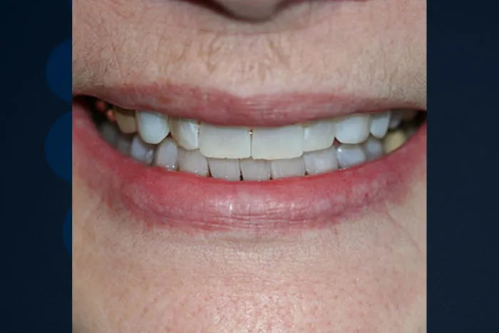 29118 at home teeth whitening