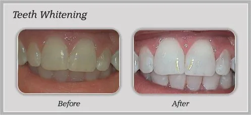 29118 professional teeth whitening