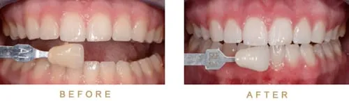 29118 teeth whitening process