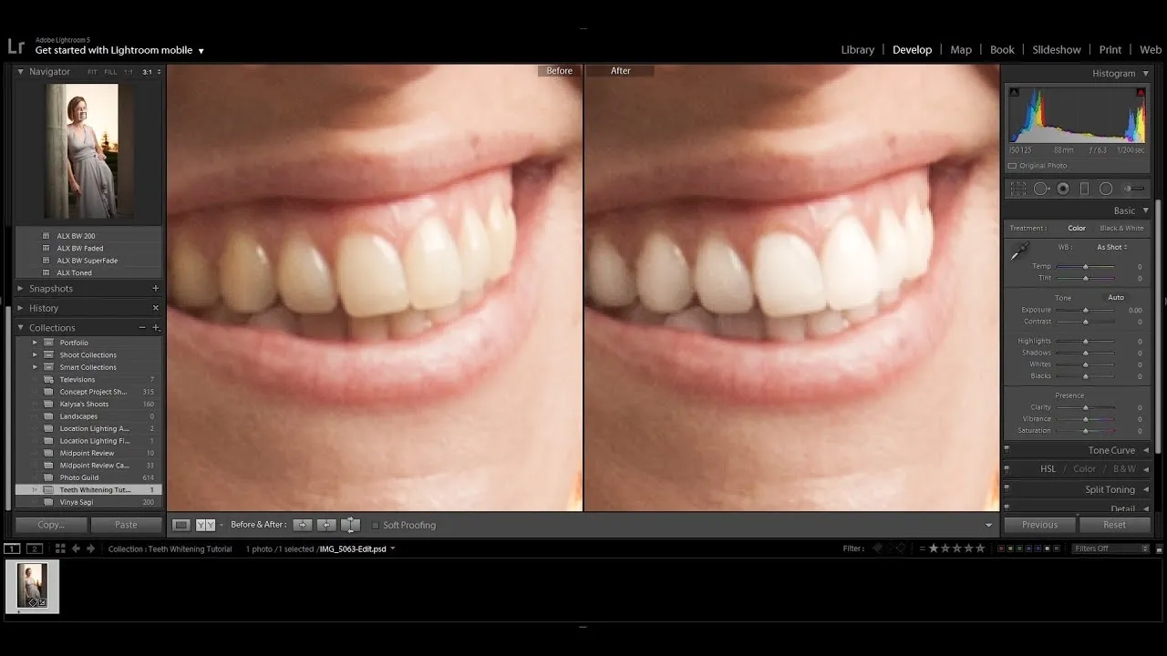 29122 teeth before after