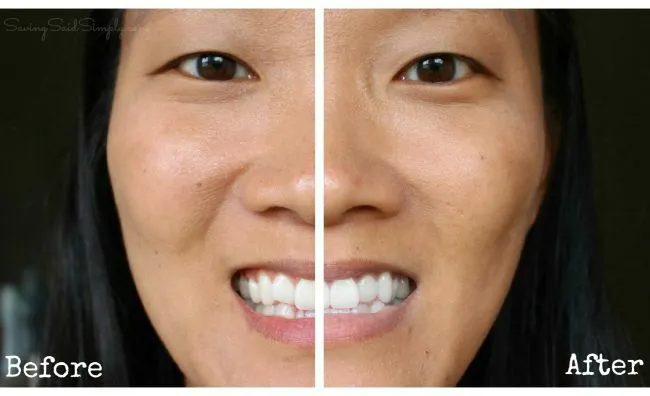 29124 teeth whitening methods