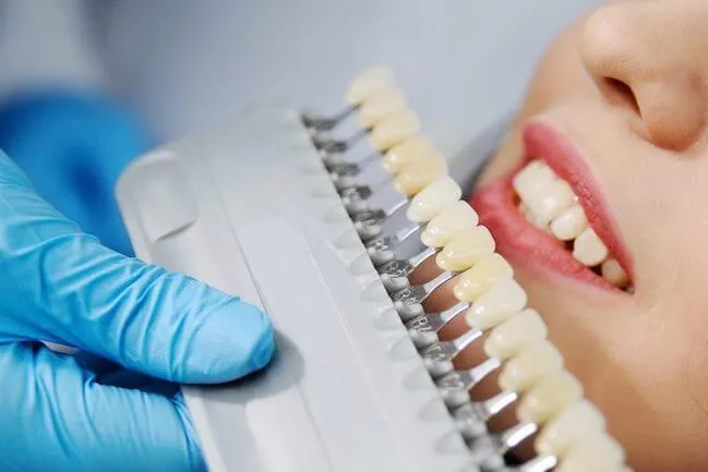 29125 teeth whitening vilnius clinic