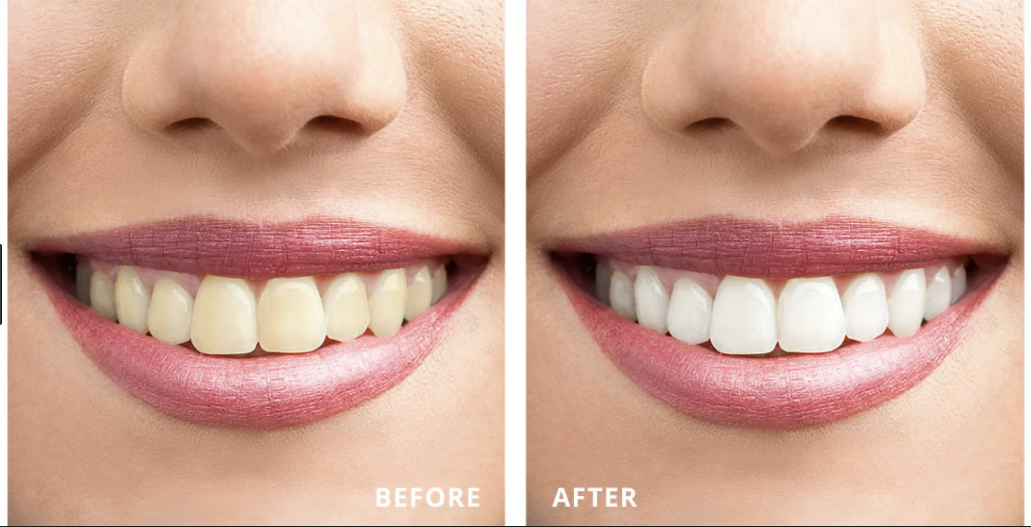 /img/29125-teeth-whitening-vilnius-cost.webp