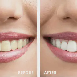 /img/29125-teeth-whitening-vilnius-cost.webp