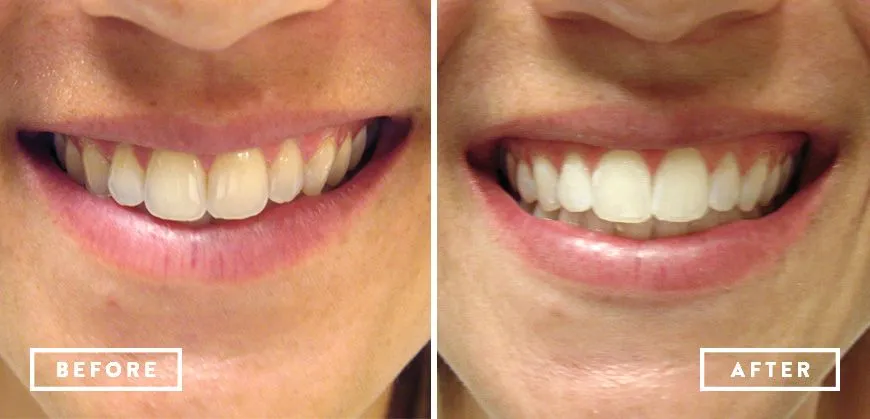 29128 teeth whitening sensitivity