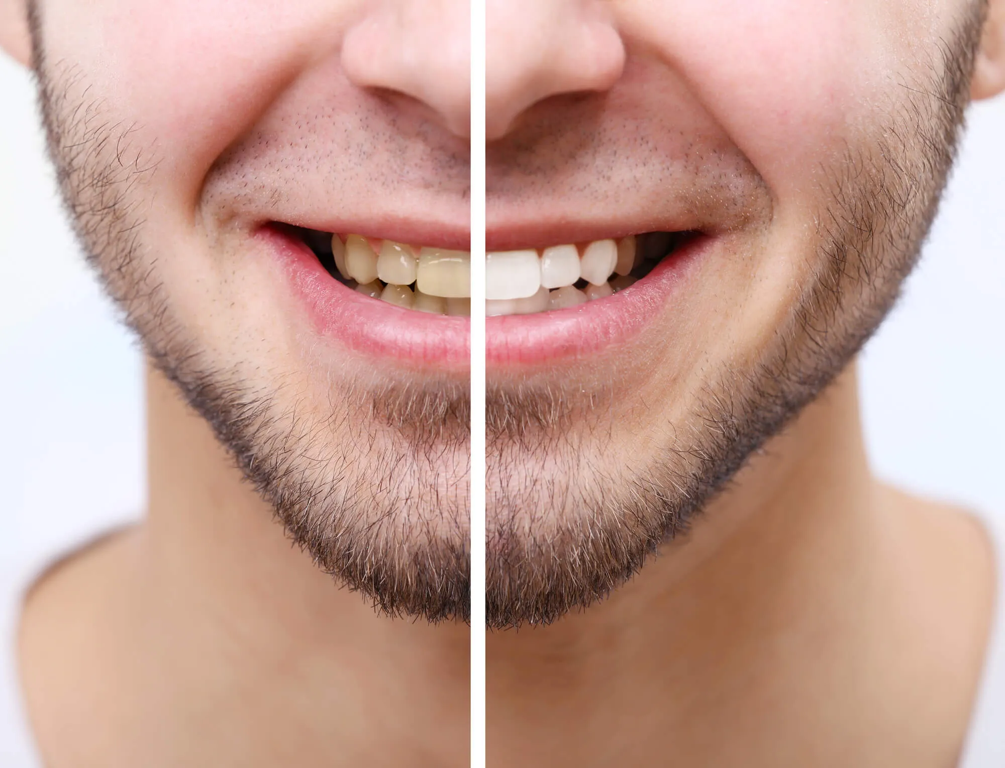 29128 whitening methods