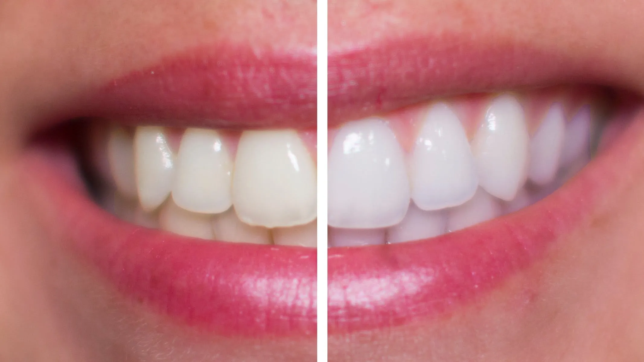 29131 teeth whitening diet