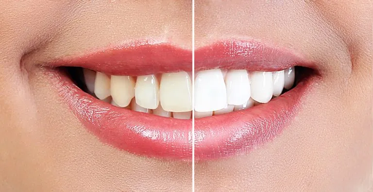 29132 in office teeth whitening