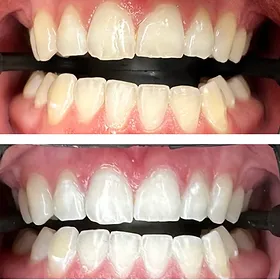 29135 smiling teeth