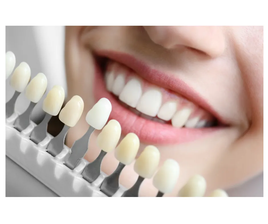 29135 teeth whitening before after
