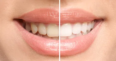 29135 teeth whitening options