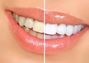 29140 in office teeth whitening