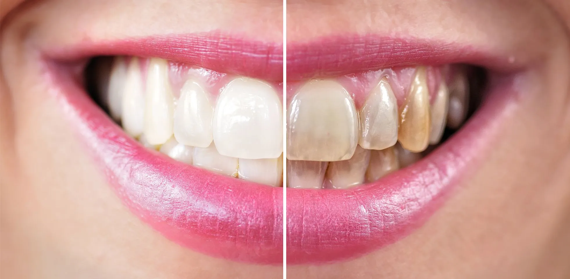 29141 whitening process